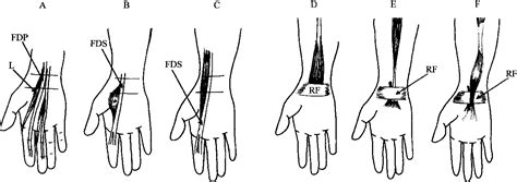 Pdf Median And Ulnar Nerve Compression At The Wrist Caused By My Xxx