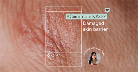 Community Asks Damaged Skin Barrier In Sync Blog By Nua
