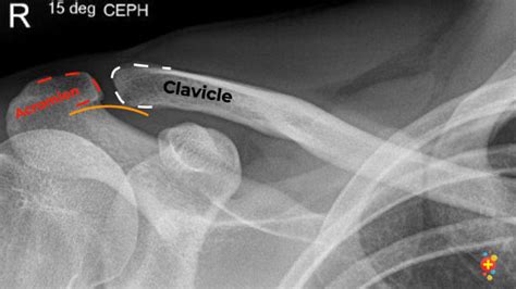 Clavicle Fractures Dont Forget The Bubbles