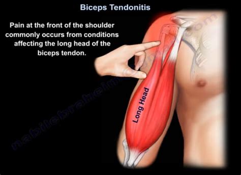 Biceps Tendonitis Orthopaedicprinciples