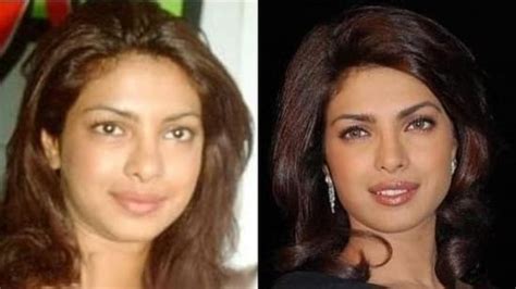 Deepika Padukone Before After Plastic Surgery