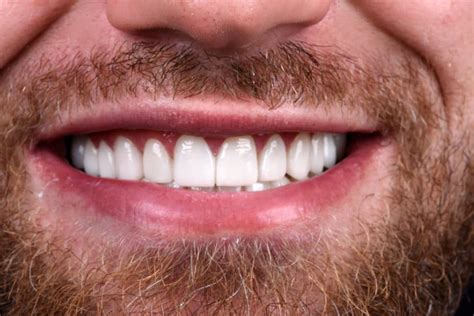 Couronne Dentaire Vip Smile Pour Vos Facettes Implants Et Soins Dentaires
