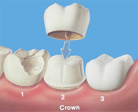 First let us check the cost estimates on. How Much Do Dental Crowns Cost? - Miosuperhealth