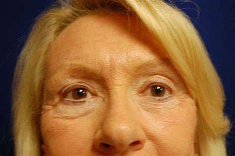 Laser Skin Resurfacing Facial Laser Resurfacing Before And After