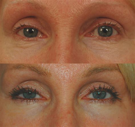 Los Angeles Fractional Laser Resurfacing For The Eyes