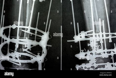 Fractura Conminuta Distal Peroné Manejada Por Placa Y Tornillos Tibia