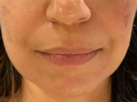 before and afterfiller lips — cpw vein and aesthetic center