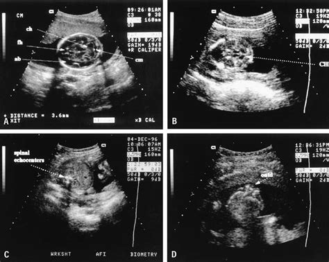 15 Baby Head Ultrasound Anatomy