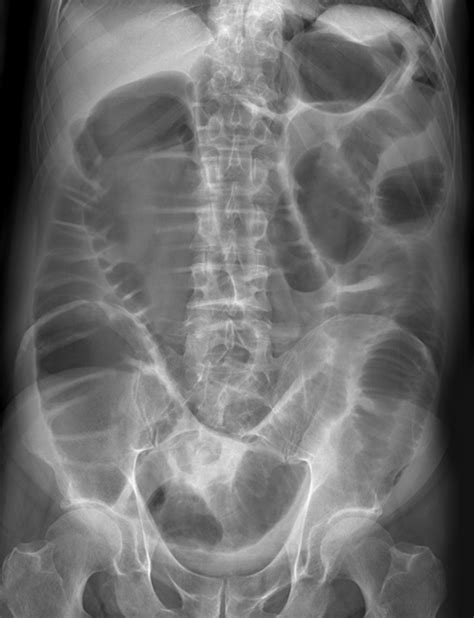 radiology masterclass test  abdominal  ray quiz
