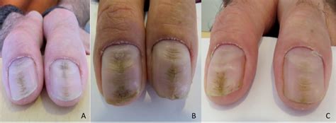 Dyshidrotic Eczema Nails