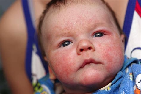 How To Treat Baby Eczema Dorothee Padraig South West Skin Health Care