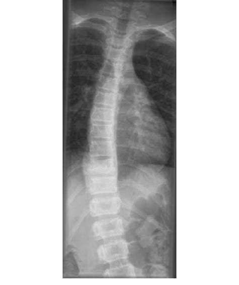 Ap Thoracic Spine Showing Right Convex Scoliosis With Cobbs Angle Of