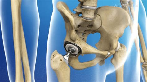 Total Hip Replacement In Florida Florida Surgery Consultants