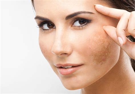 Aprenda Quais São Os Tratamentos Para Melasma Revista Saúde