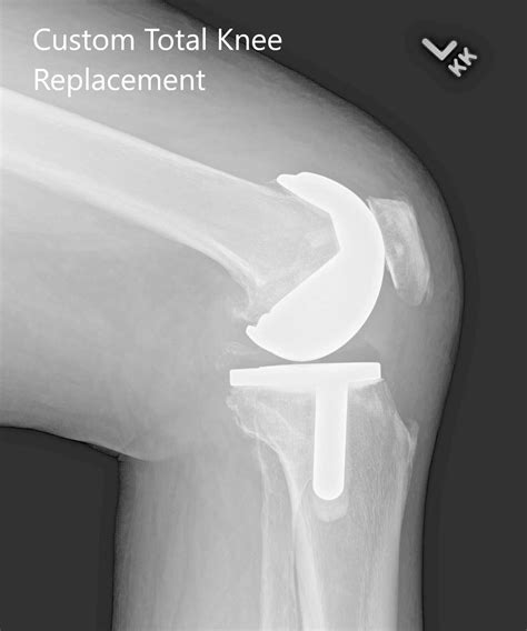 Case Study Custom Left Knee Replacement In 66 Yr Old Male