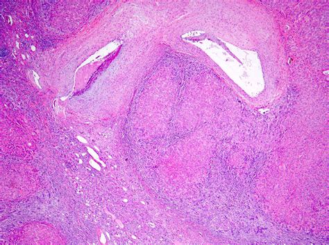 Pathology Outlines Focal Nodular Hyperplasia