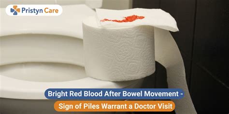 Bright Red Blood After Bowel Movement Sign Of Piles Warrant A Doctor