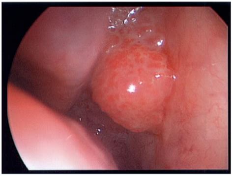 Frontiers Pathologic Collision Of Inverted Papilloma With