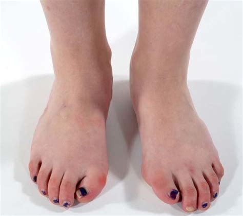 Clinical Photograph Of Both Feet Showing Bilateral Hallux Valgus