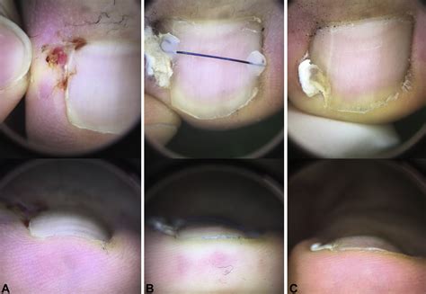 A Noninvasive Method For Treating Ingrown Nail Recurrence Due To