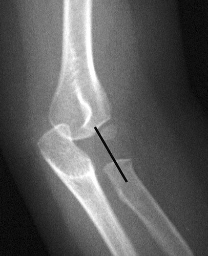 Nursemaid Elbow Revisited And A Review Of Congenital Radioulnar