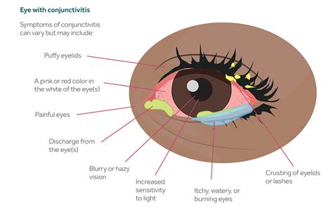 Conjunctivitis Or Pink Eye