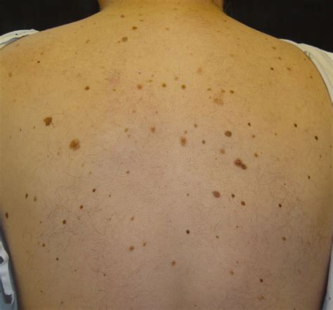 Brown Spots On Back Pictures Photos