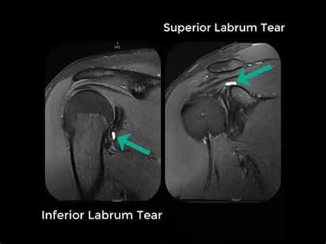 Labral Tear And Slap Tear Of The Shoulder Complete Mri My Xxx Hot Girl