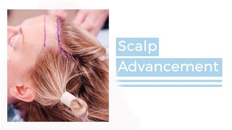 Facial Plastic Surgery Scalp Advancement Or Forehead Lowering With Dr