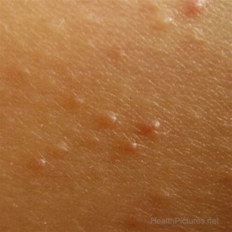 Keratosis Pilaris Is Appearance Of Red Bumps On Skin Musely