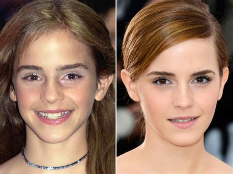 Did Emma Watson Have Implants Lets Have A Look Verge Campus