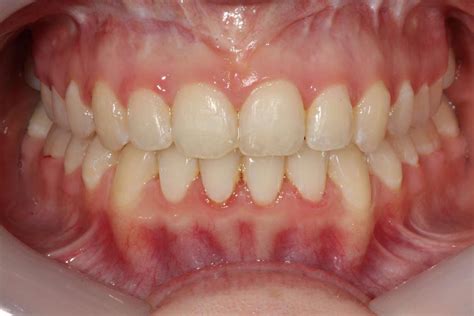 Anterior Open Bites Align Dentistry Blog Call 02 9723 5757