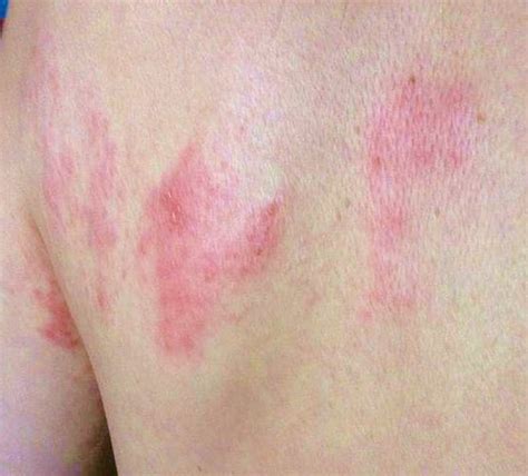Early Shingles Rash Pictures To Pin On Pinterest Pinsdaddy