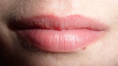 Small White Bumps On Lips Causes And Treatment