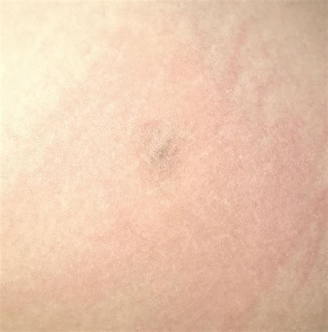 Brown Recluse Spider Bite Early Stages Photo
