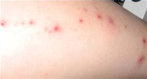 Skin Rash With Blisters