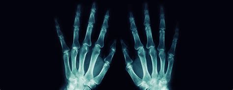 Hand X Ray