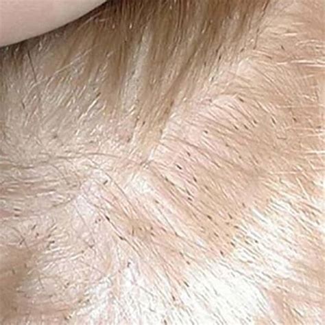 Finding Head Lice In Blonde Hair