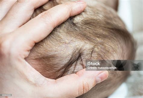 Cradle Cap Or Infantile Seborrheic Dermatitis Stock Photo Download