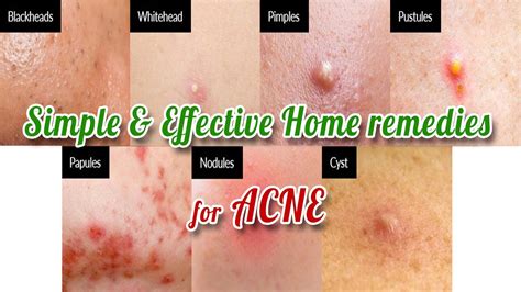 How To Treat Different Types Of Acnes How To Get Rid Of Acnes Acne