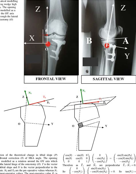 Modification Of Tibial Slope After Medial Opening Wedge High Tibial