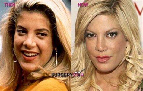 Tori Spelling Reveals Had The Worst Luck Of Plastic Surgery Nose