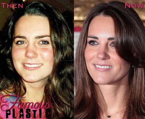 Kate Middleton Rhinoplasty Surgery