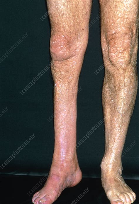 Leg Muscle Wasting Stock Image M3300897 Science Photo Library