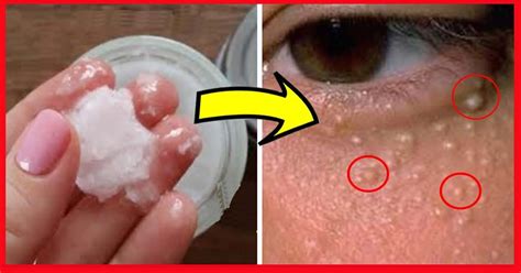 Que son esas bolitas blancas que aparecen alrededor de los ojos y cómo removerla con esta receta