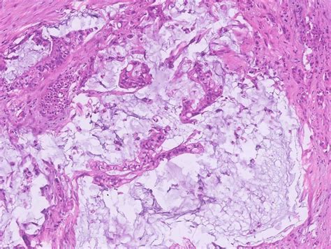 Colloid Carcinoma Not Associated With Intraductal Papillary Mucinous