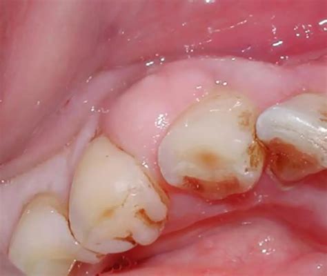 Hard Lump On Gum Below Tooth