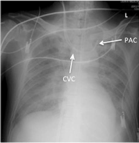 Femoral Venous Catheter