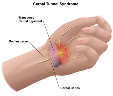 Carpal Tunnel Syndrome Hand Cts Carpal Tunnel Disorder Treatment