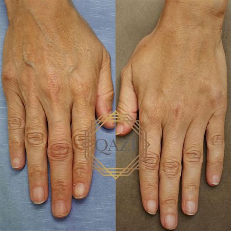 Hand Rejuvenation How To Stop The Signs Of Aging Hands